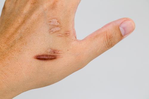A person with scars on their hand after a dog attack.