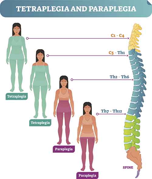 Tetraplegia and paraplegia diagram with back bone cross section