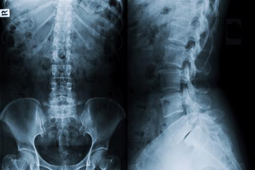 An x-ray pf a spinal cord showing an injury.