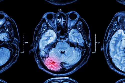 A brain scan highlighting an injury.