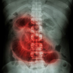 <span>New York </span>Hernia Mesh Lawsuit This image shows an x-ray of an intestinal obstruction.