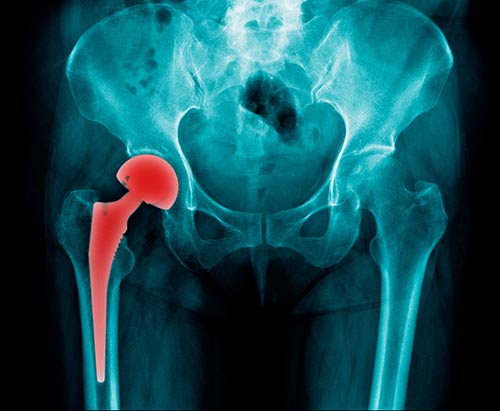 This image shows an x-ray of a hip implant.