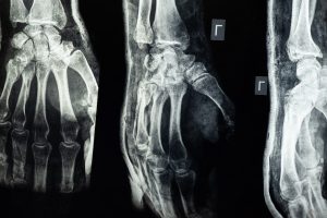 What Injuries Require An Injury Attorney?