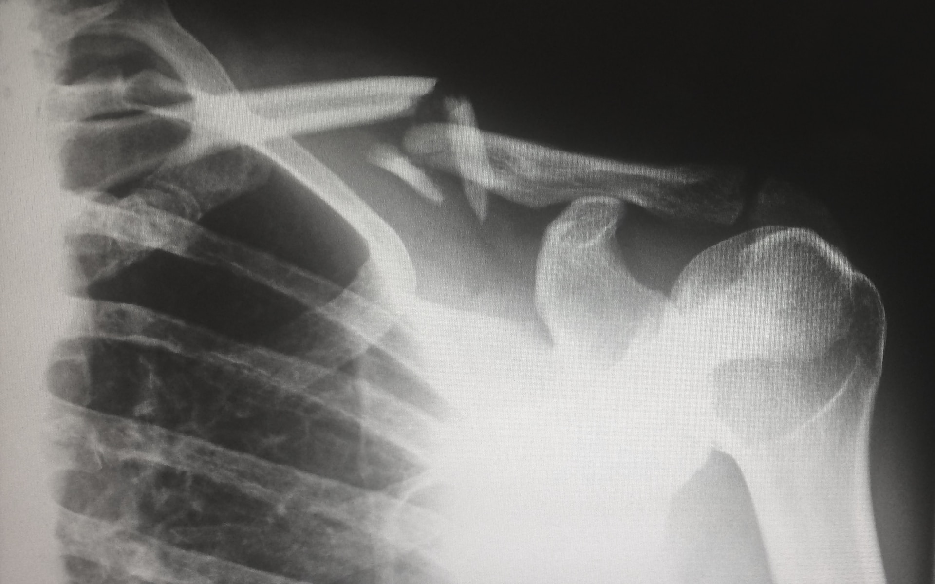New York catastrophic injury lawyer