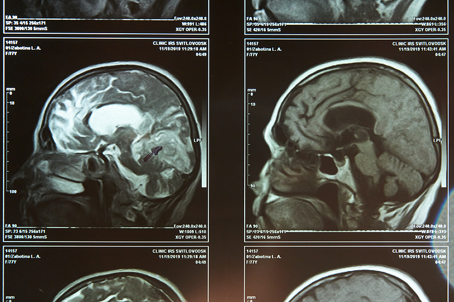 Traumatic brain injuries after being involved in an accident.