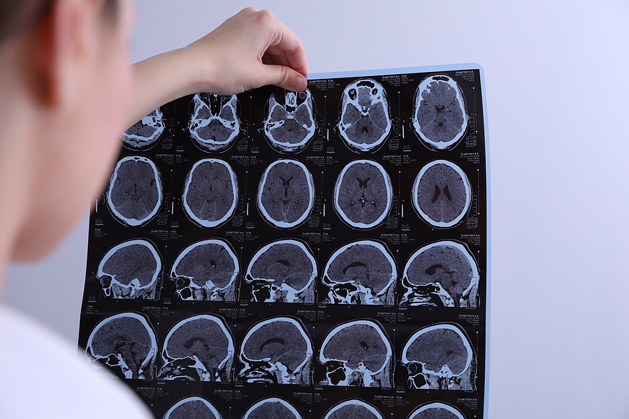 The Steep Cost of a Brain Injury