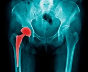 <span>New York </span>Hip Replacement Lawsuit This image shows an x-ray of a hip implant.