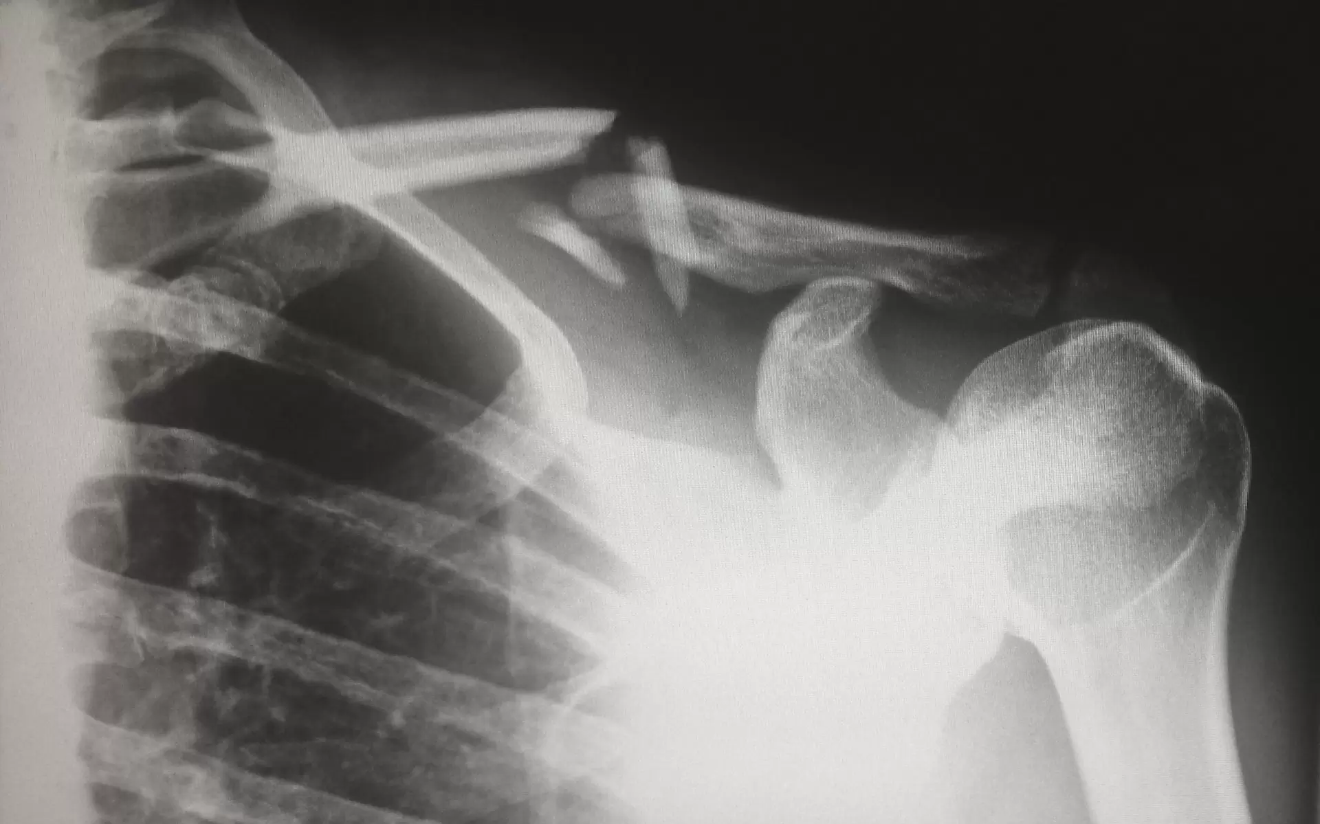New York catastrophic injury lawyer